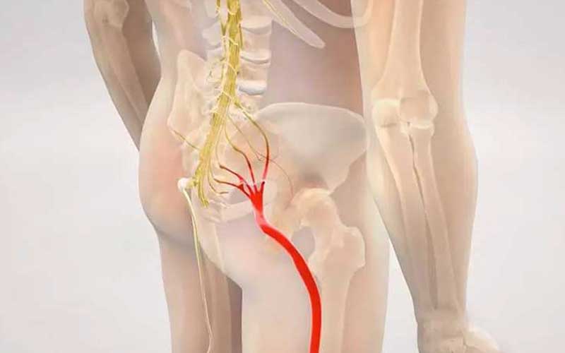 سیاتیک چیست و چگونه بدون جراحی درمان میشود؟