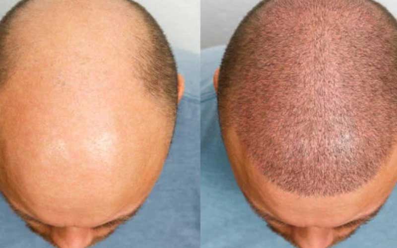 بهترین سن برای کاشت مو چه زمانی است؟